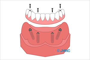 ALL-ON-4（オールオンフォー） イメージ画像