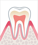 歯肉炎 イメージ画像