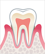 軽度歯周病 イメージ画像