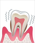 重度歯周炎 イメージ画像
