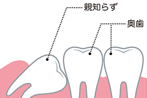 親知らずの抜歯 イメージ画像